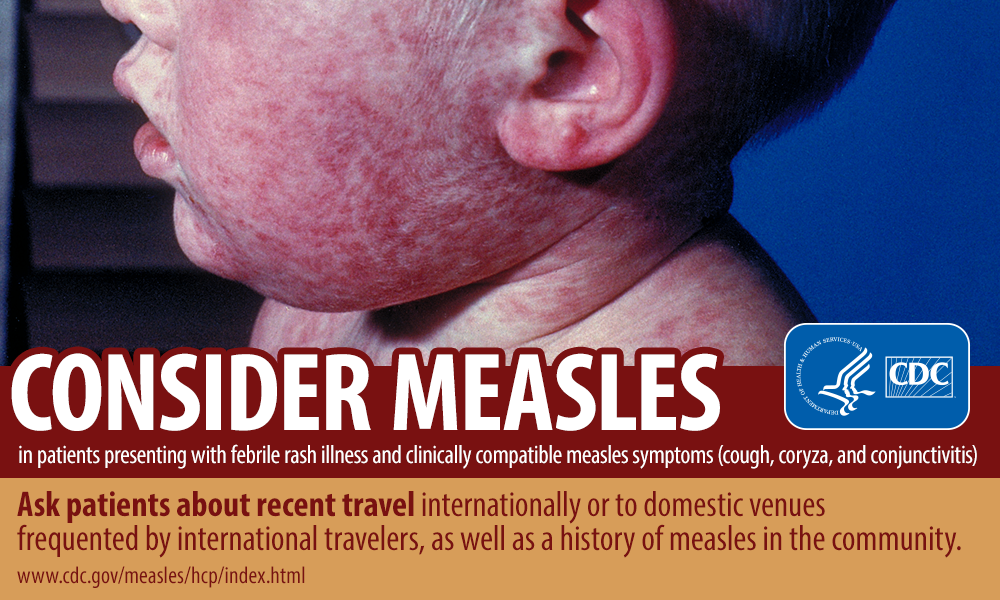 CDC Consider Measles