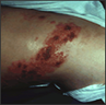 Herpes Zoster Virus (Shingles)